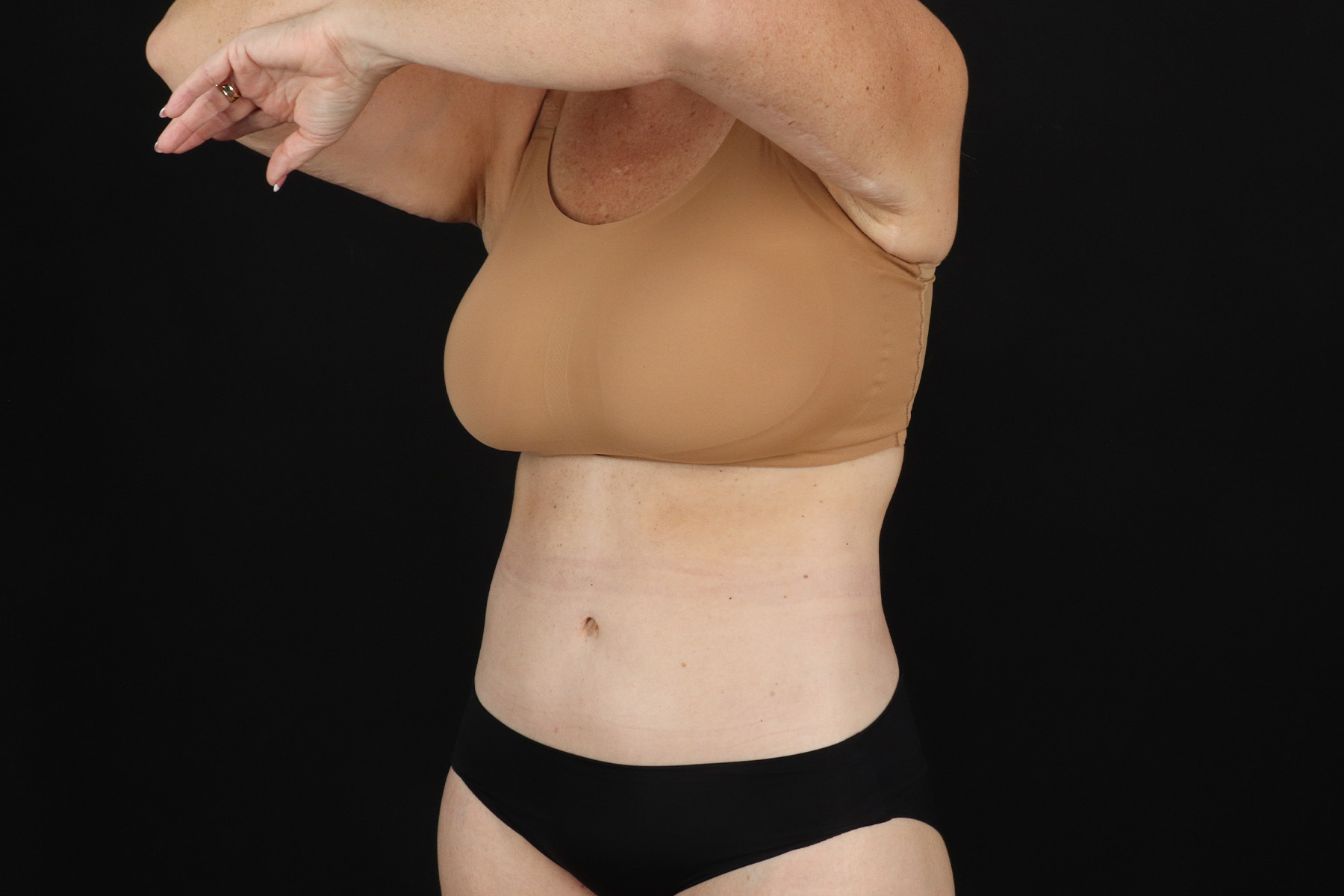 Cosmetic Body Lift Before & After Patient #9767