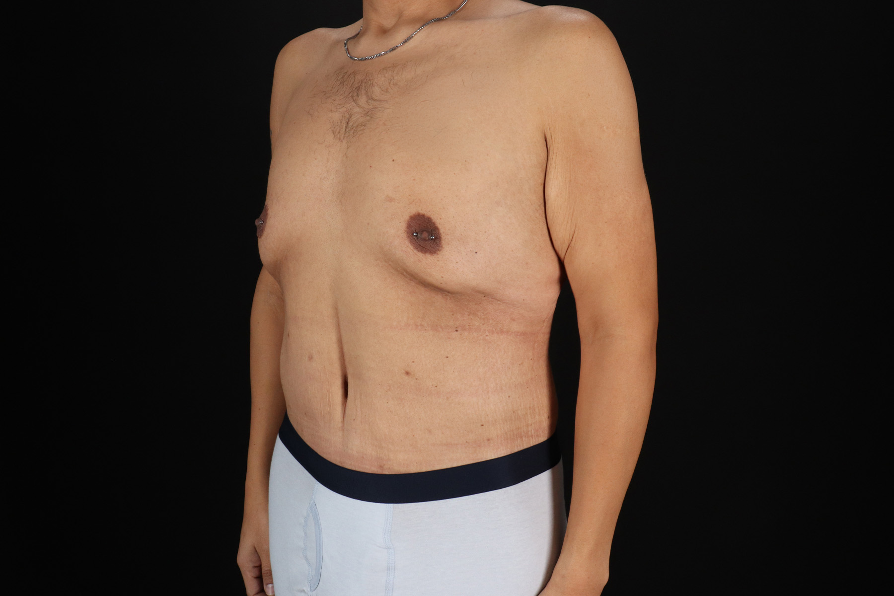 Cosmetic Body Lift Before & After Patient #9764