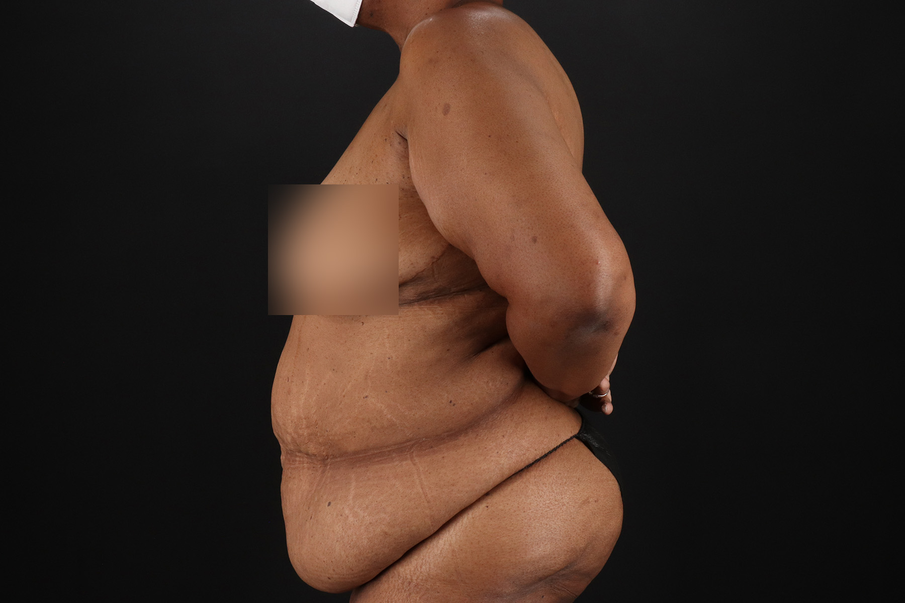 Cosmetic Body Lift Before & After Patient #9761