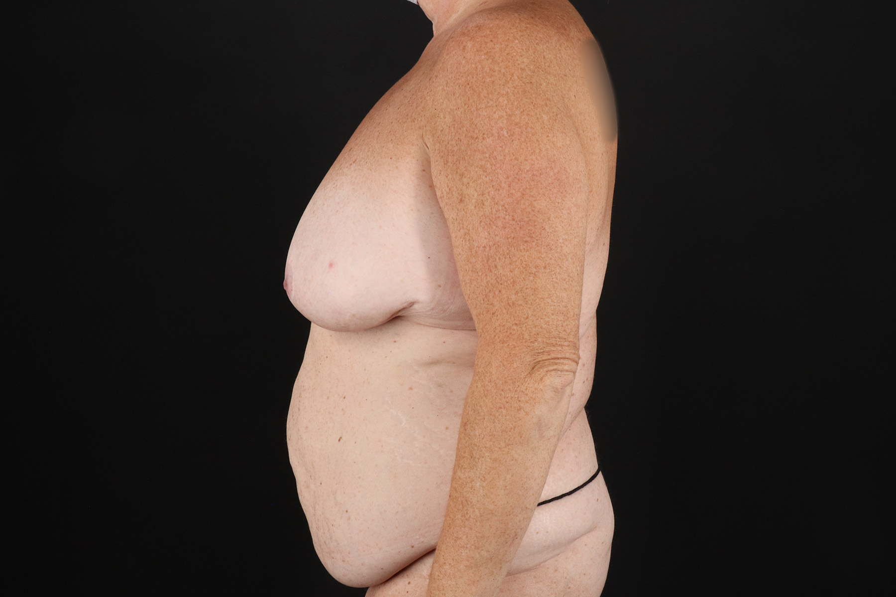 Cosmetic Body Lift Before & After Patient #9763