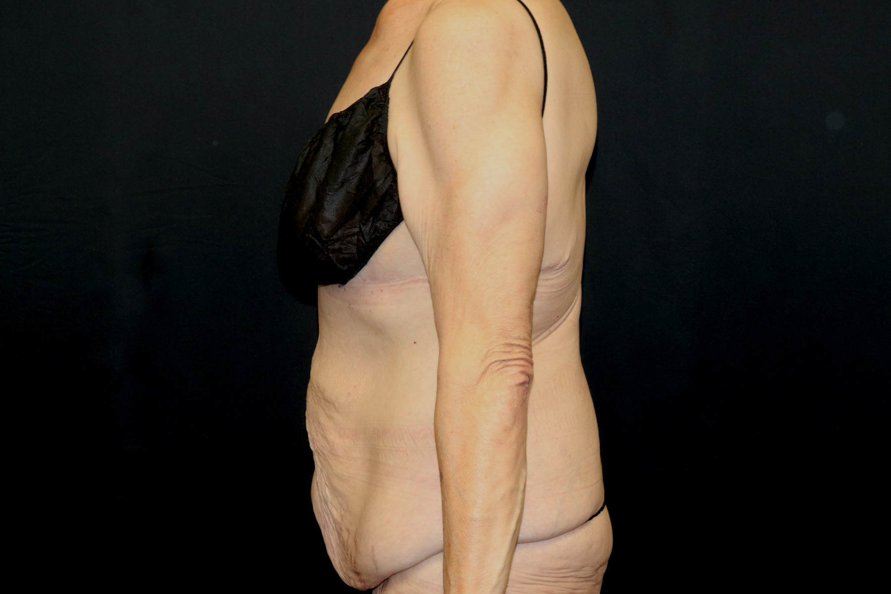 Cosmetic Body Lift Before & After Patient #9762