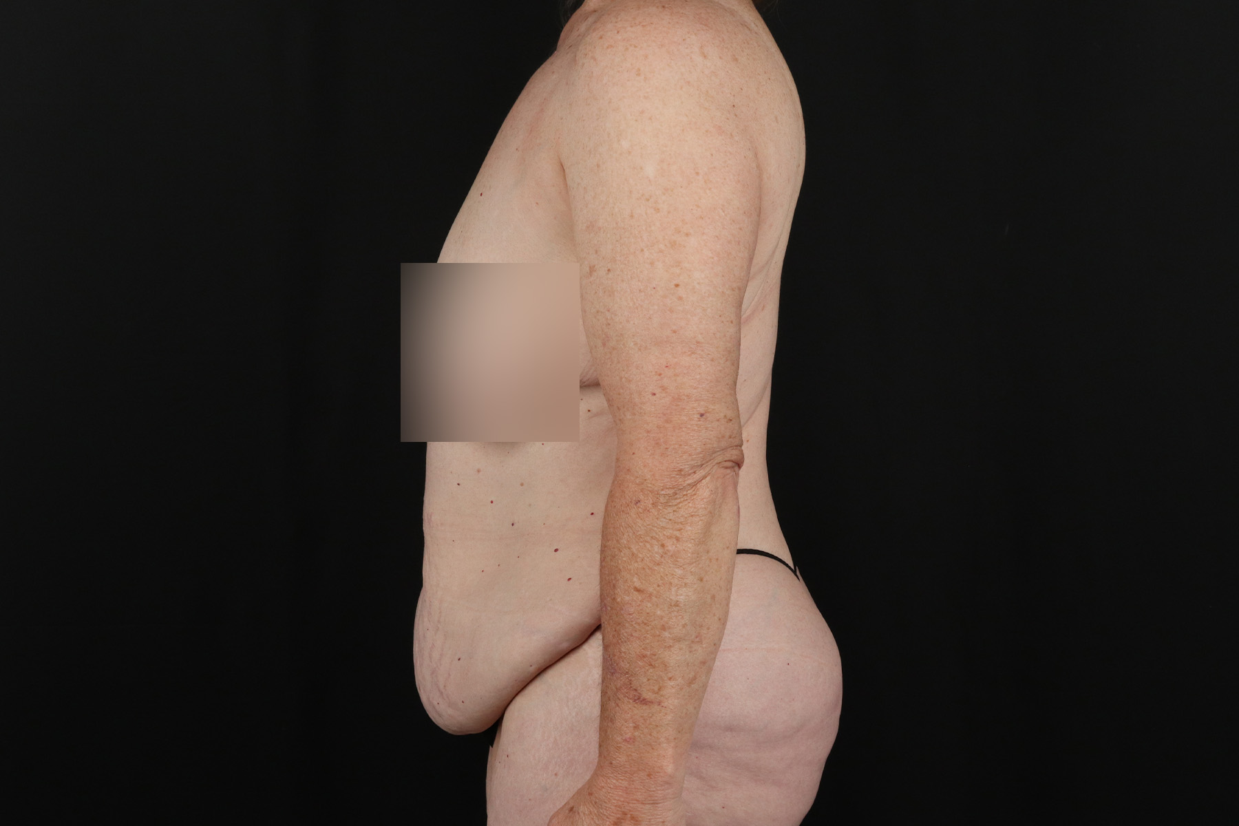 Cosmetic Body Lift Before & After Patient #9757