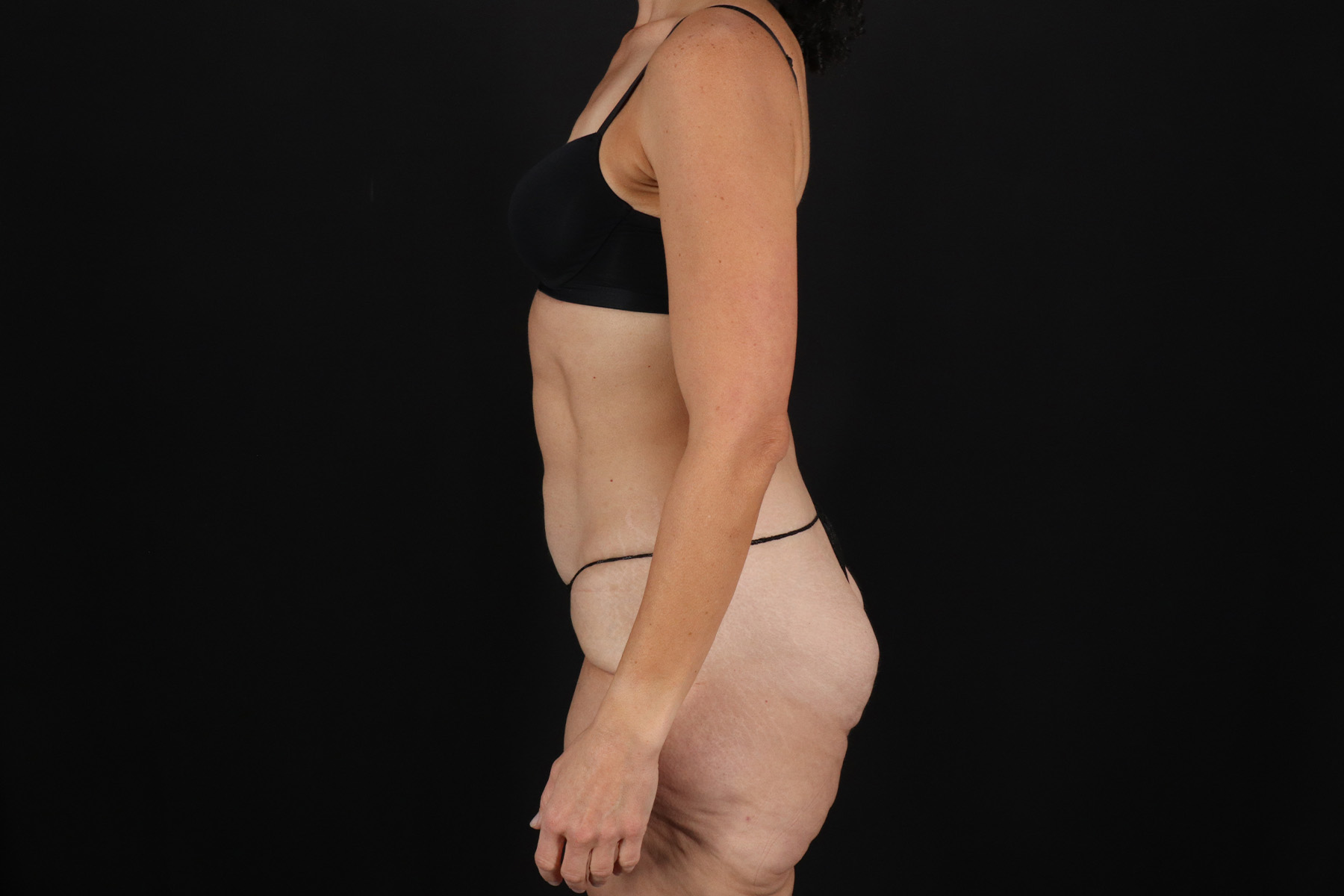 Cosmetic Body Lift Before & After Patient #9760