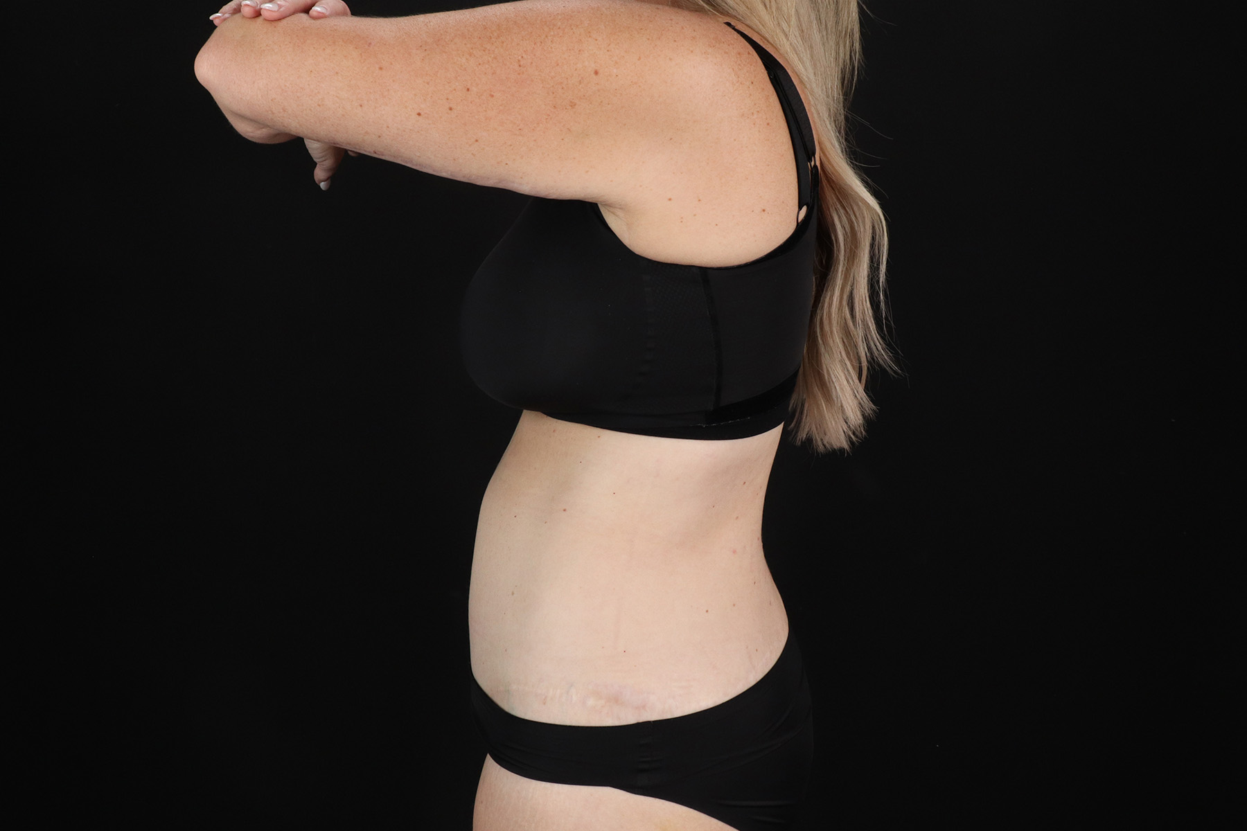 Cosmetic Body Lift Before & After Patient #9767