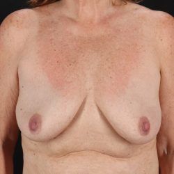 Breast Implant Revision Before & After Patient #11224