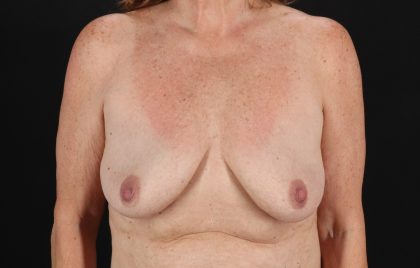 Breast Implant Revision Before & After Patient #11224