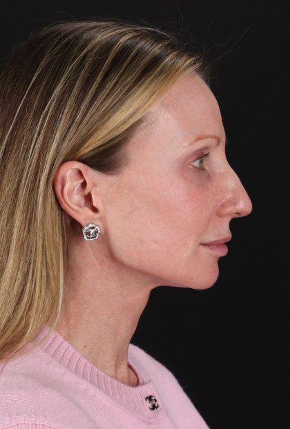 Fat Grafting To The Face Before & After Patient #11861