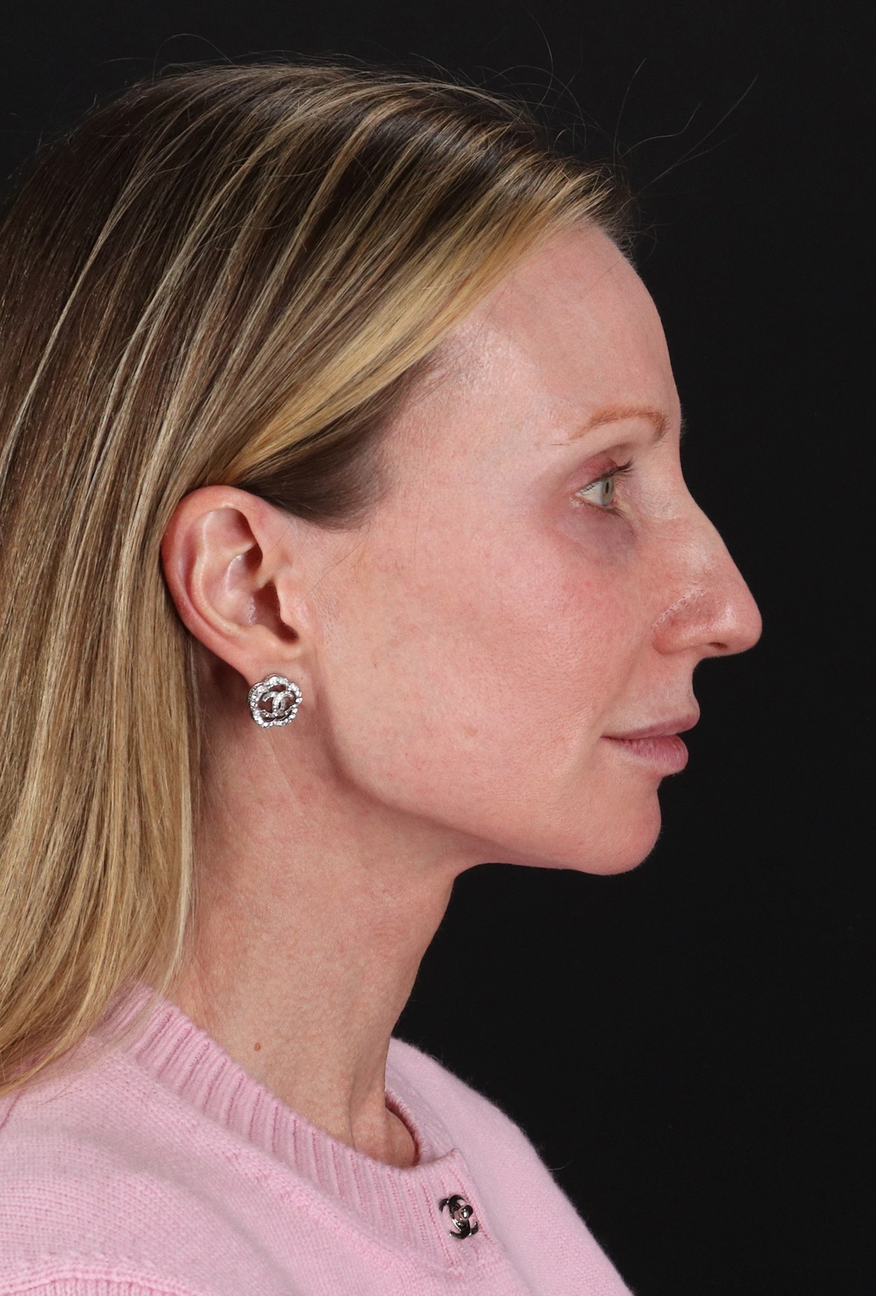 Facelift Before & After Patient #11700