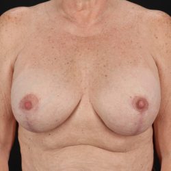 Breast Implant Revision Before & After Patient #11224