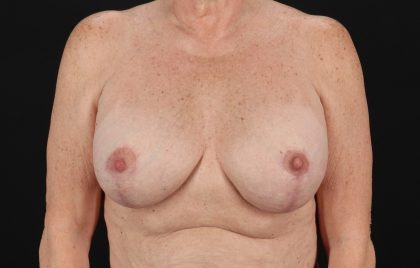 Breast Implant Revision Before & After Patient #11224