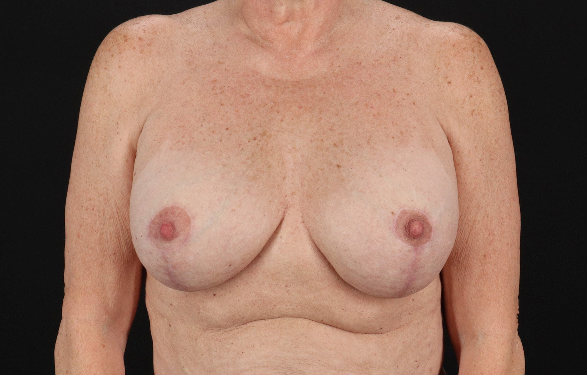 Breast Implant Revision Before & After Patient #11224