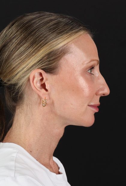 Fat Grafting To The Face Before & After Patient #11861
