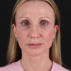Facelift Before & After Patient #11700