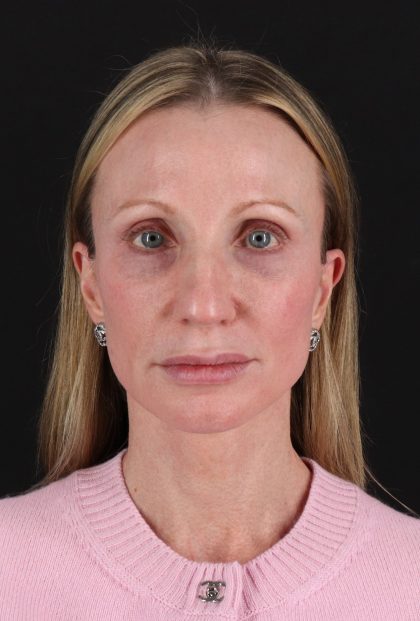 Fat Grafting To The Face Before & After Patient #11861