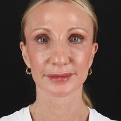 Fat Grafting To The Face Before & After Patient #11861