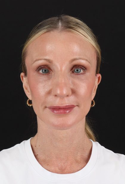 Fat Grafting To The Face Before & After Patient #11861