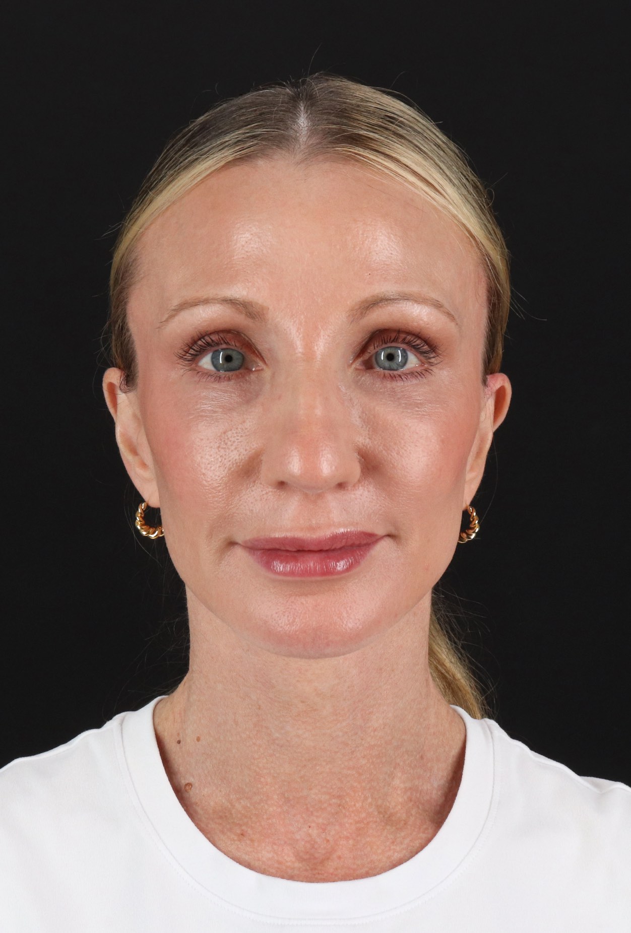 Facelift Before & After Patient #11700