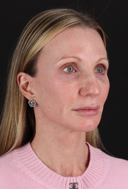 Facelift Before & After Patient #11700