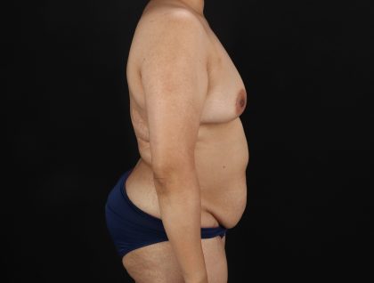 Mommy Makeover Before & After Patient #11268