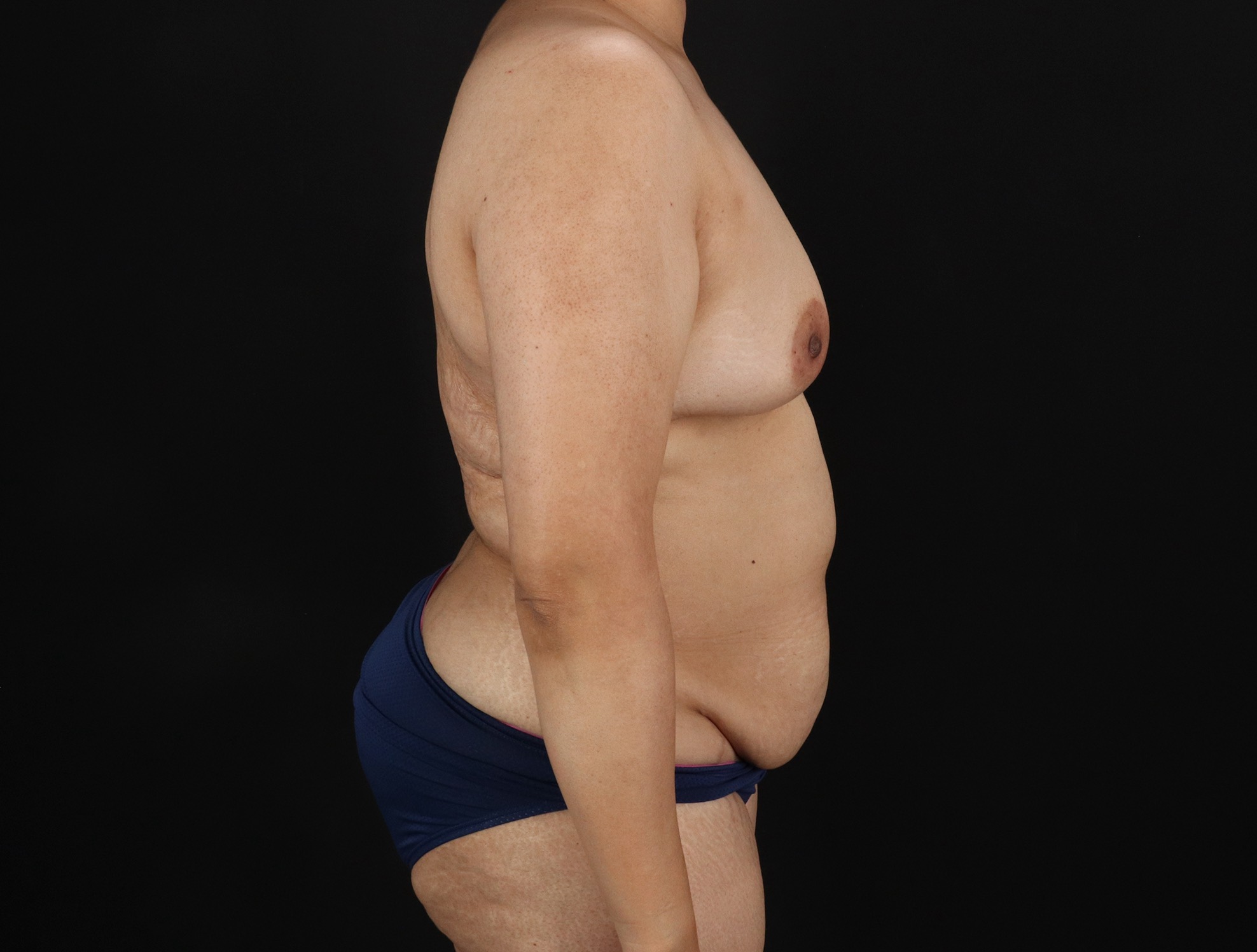 Mommy Makeover Before & After Patient #11268