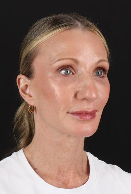 Facelift Before & After Patient #11700