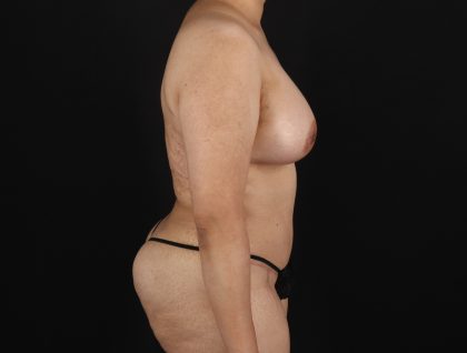 Mommy Makeover Before & After Patient #11268