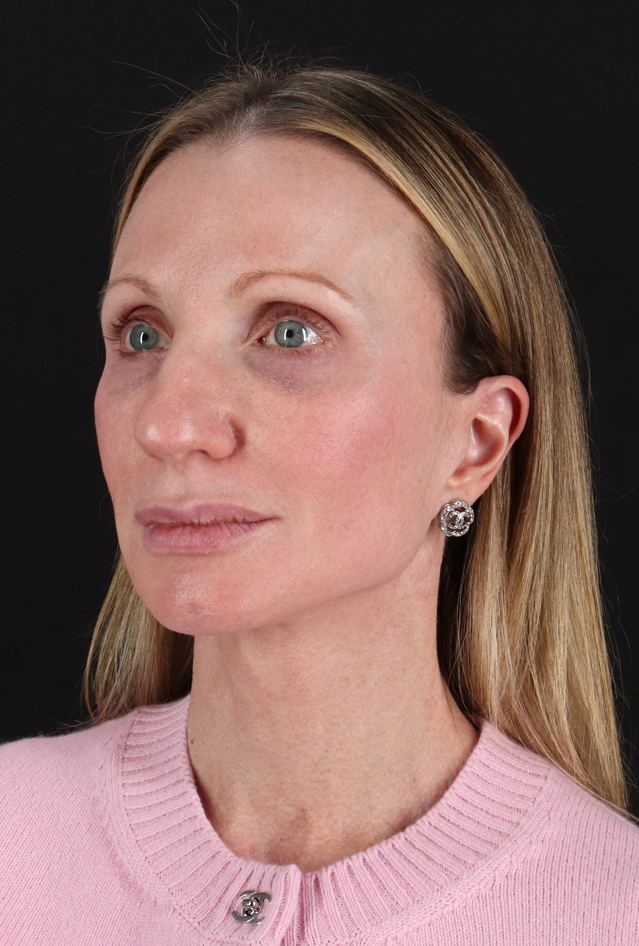 Facelift Before & After Patient #11700