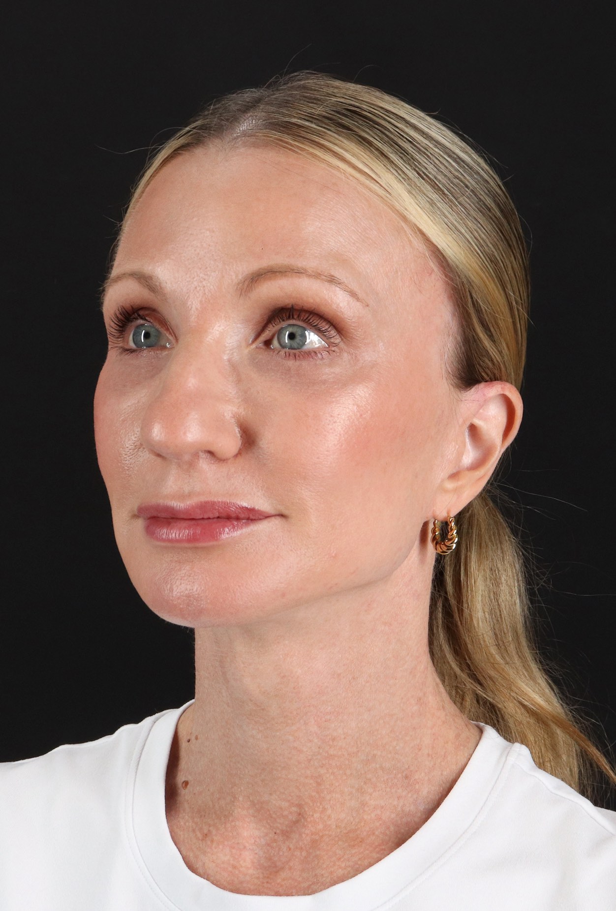 Facelift Before & After Patient #11700
