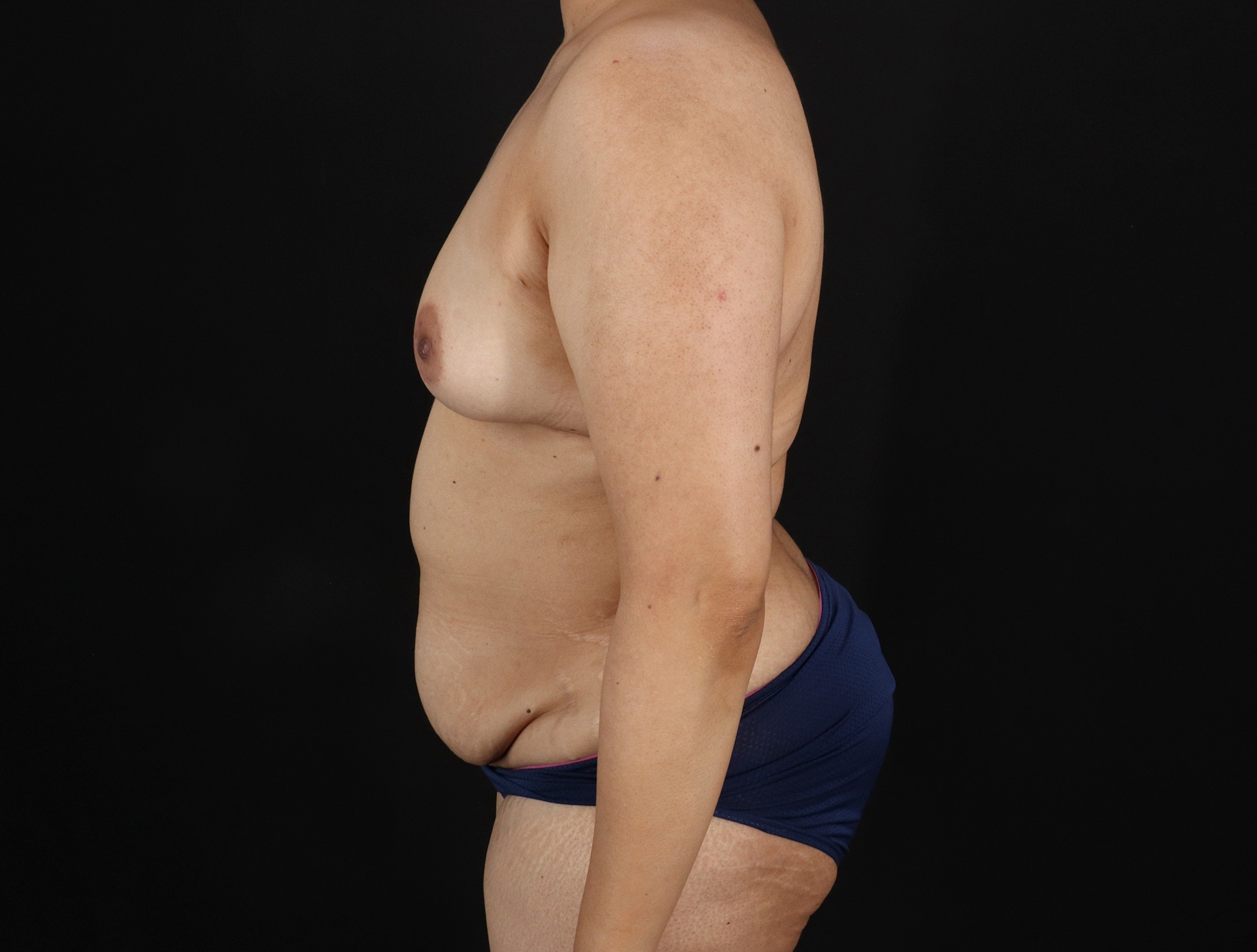 Mommy Makeover Before & After Patient #11268
