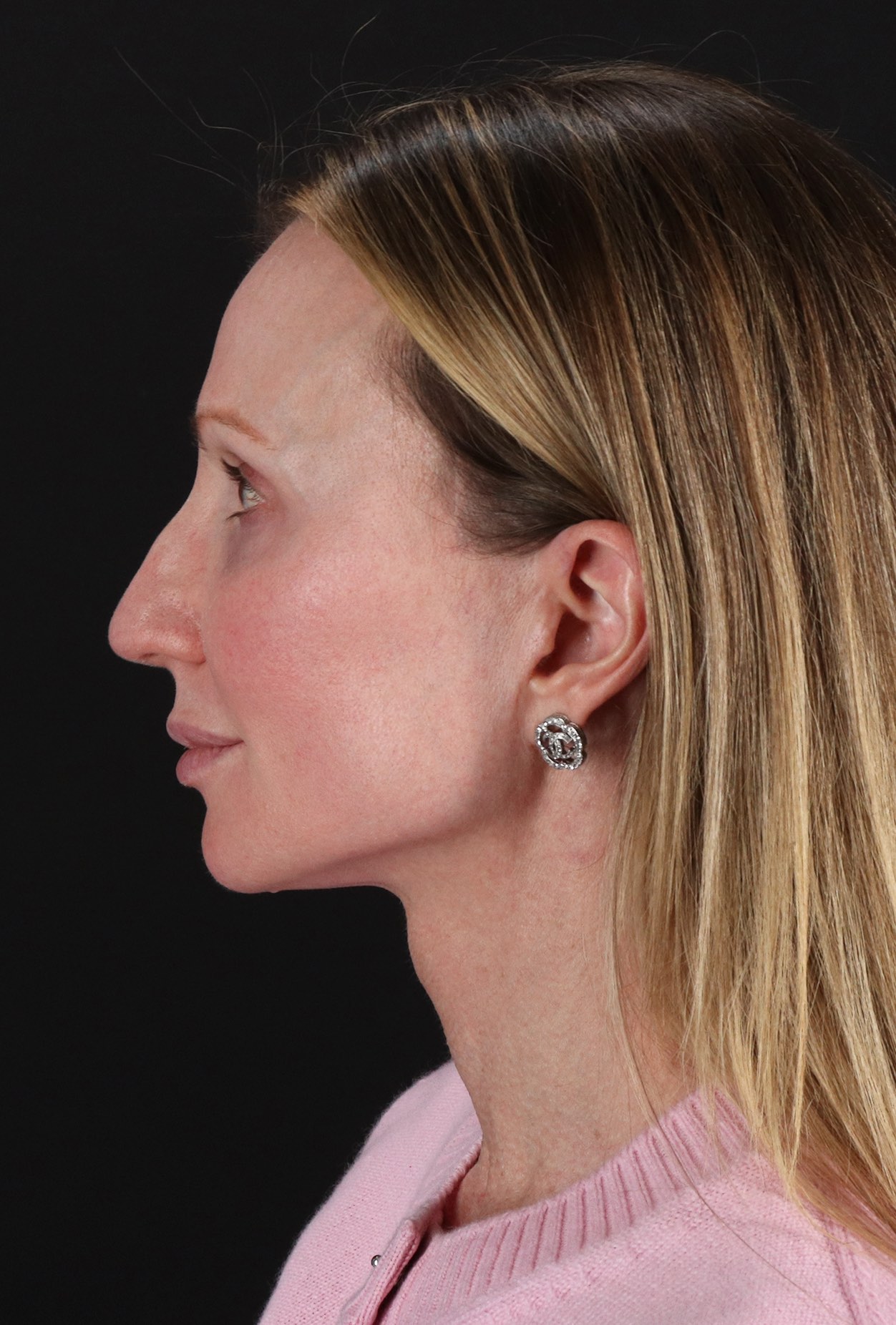 Fat Grafting To The Face Before & After Patient #11861