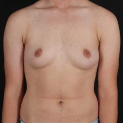 Female To Male Breast Before & After Patient #9981