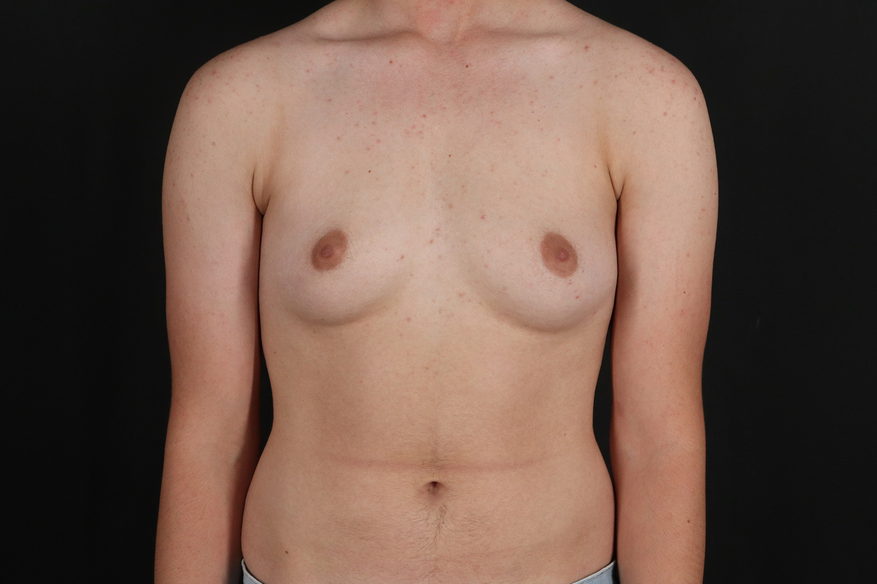 Female To Male Breast Before & After Patient #9981