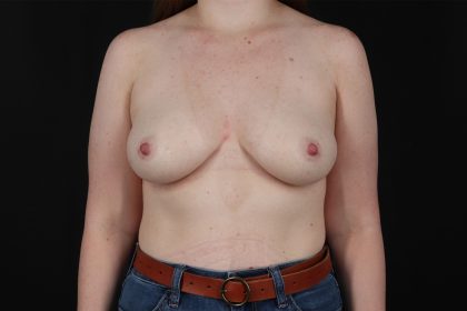 Breast Augmentation with Implants Before & After Patient #9977