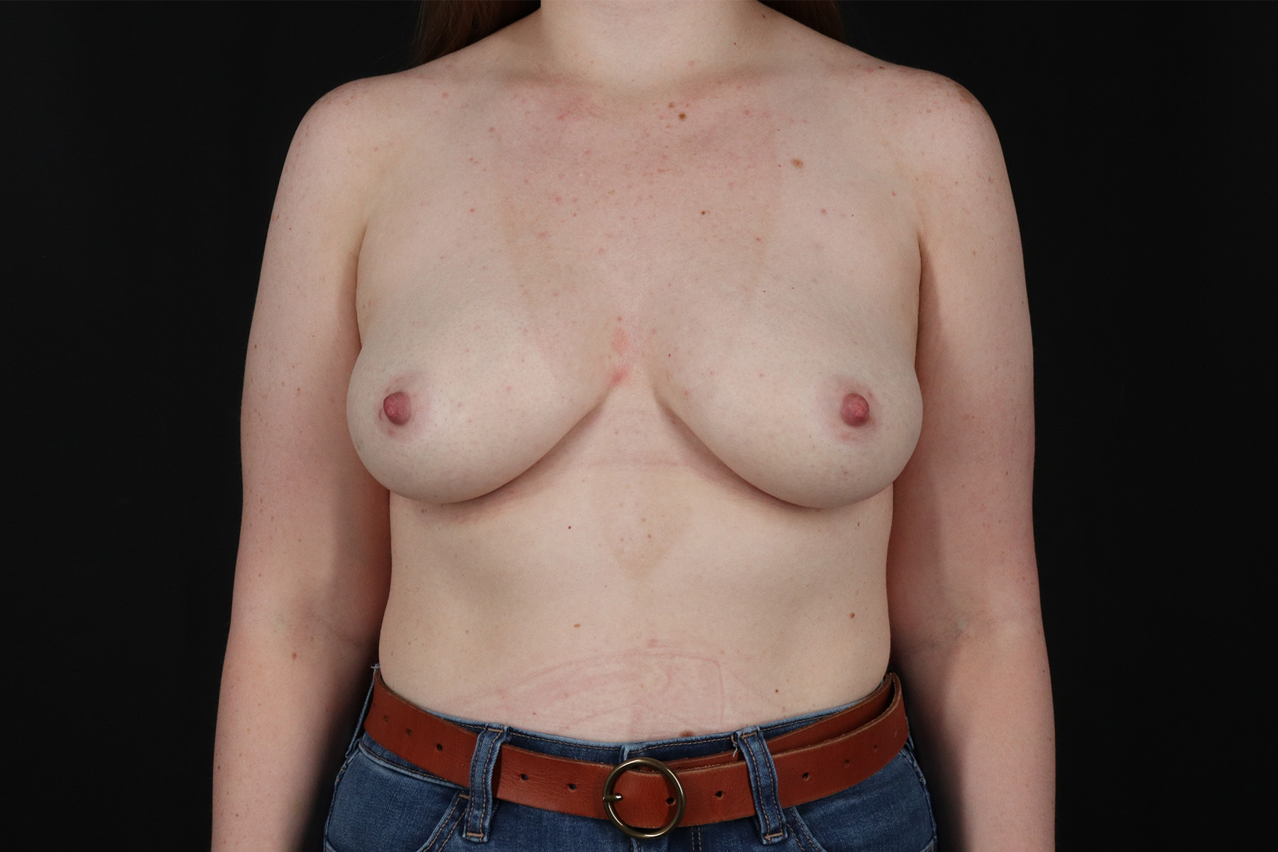 Breast Augmentation with Implants Before & After Patient #9977