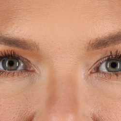 Blepharoplasty (Eyelid Surgery) Before & After Patient #9979