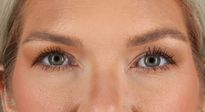 Blepharoplasty (Eyelid Surgery) Before & After Patient #9979