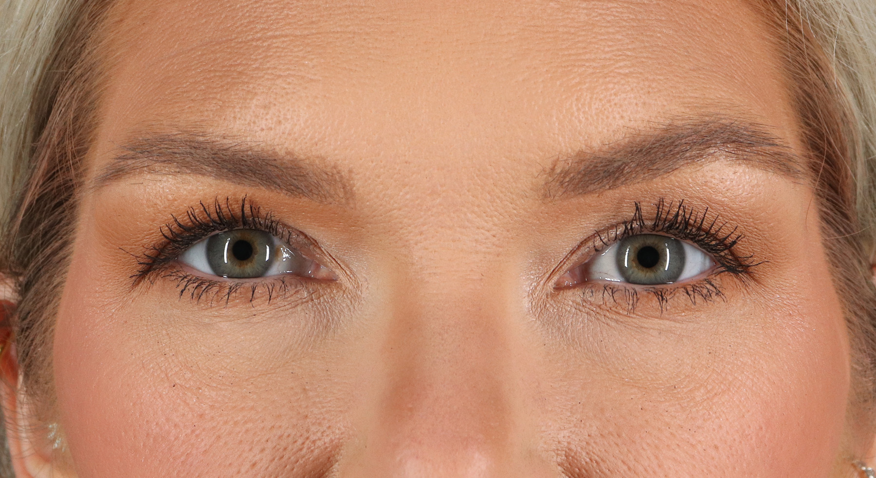 Blepharoplasty (Eyelid Surgery) Before & After Patient #9979