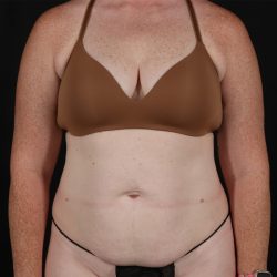 Abdominoplasty (Tummy Tuck) Before & After Patient #9980