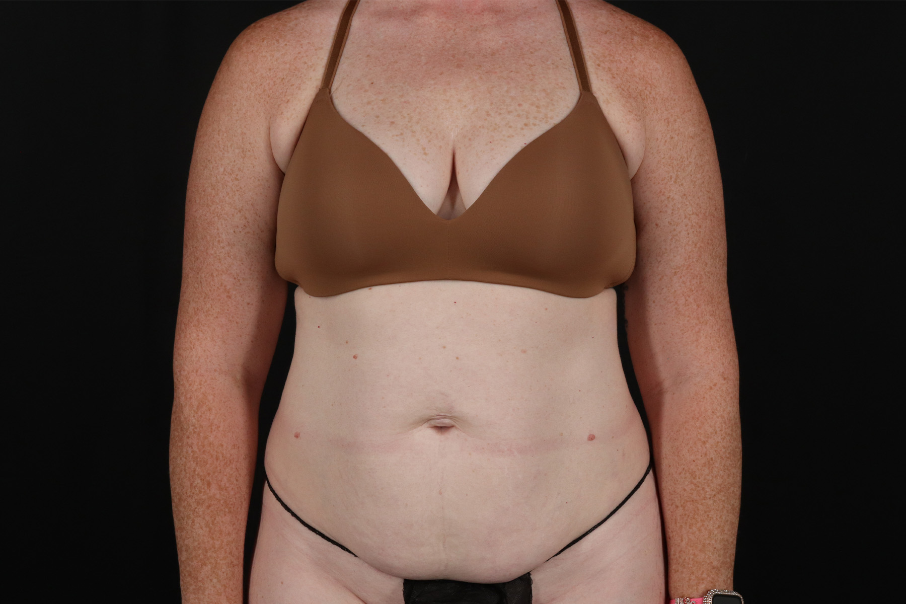 Abdominoplasty (Tummy Tuck) Before & After Patient #9980