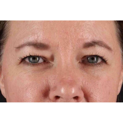 Brow Lift Before & After Patient #10859