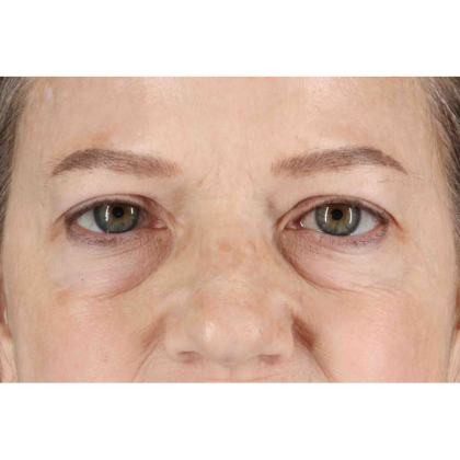 Brow Lift Before & After Patient #10848