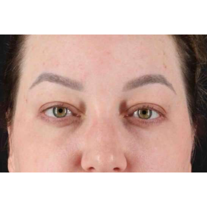 Brow Lift Before & After Patient #10837