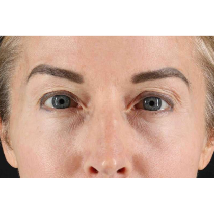 CO2 Laser Before & After Patient #10551