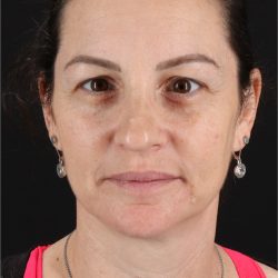 Chemical Peels Before & After Patient #11418