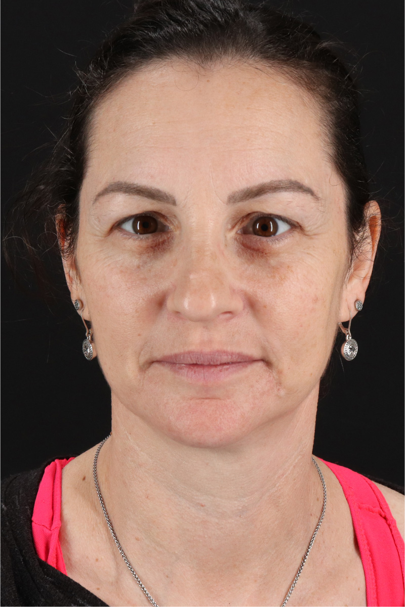 Chemical Peels Before & After Patient #11418
