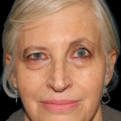 Upper Blepharoplasty Before & After Patient #11996