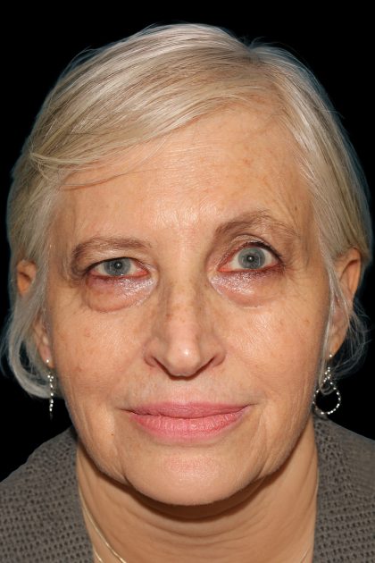 Upper Blepharoplasty Before & After Patient #11996