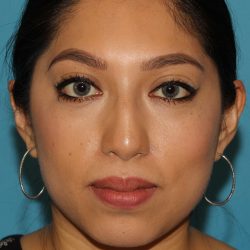 Chin Implant Before & After Patient #13673