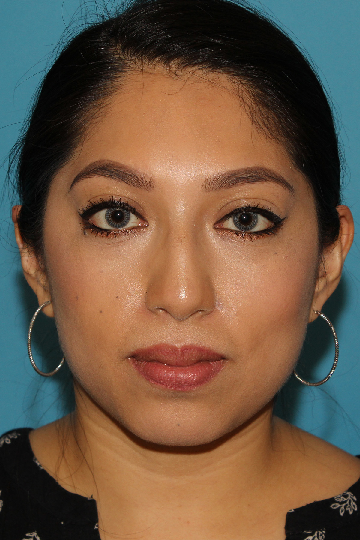 Chin Implant Before & After Patient #13673