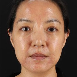 CO2 Laser Before & After Patient #11059